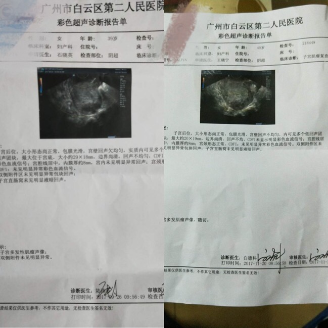 子宫肌瘤 子宫肌瘤