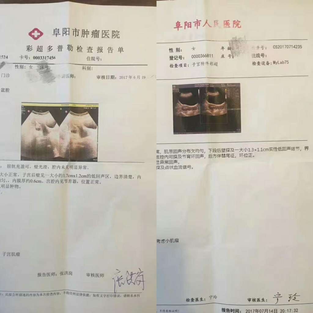子宫肌瘤 子宫肌瘤
